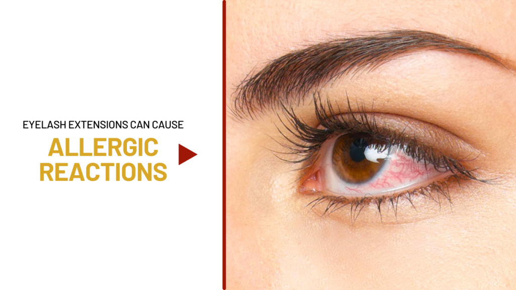 Allergic Reactions due to eyelash extensions
